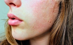 Adult Acne